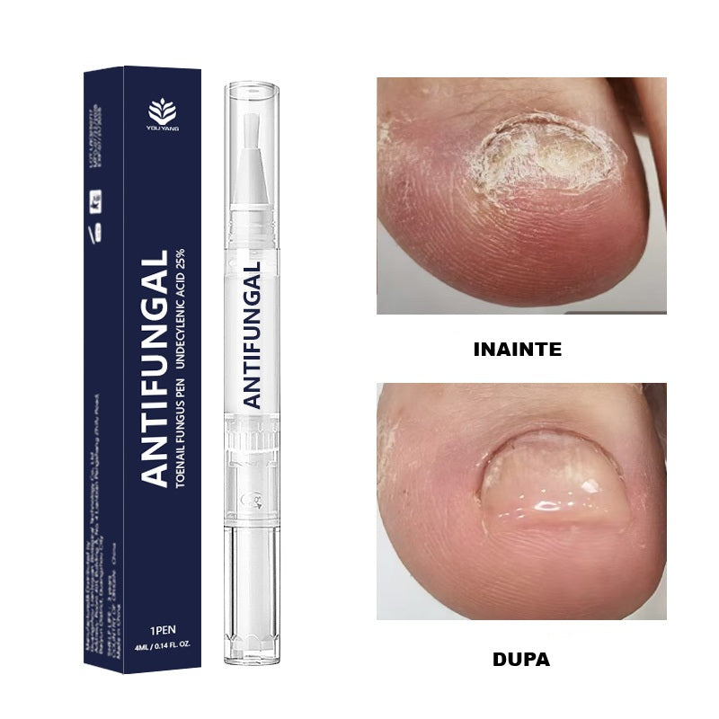 Stiloul Antifungic cu Acid Undecilenic — Pătrunde Adânc în Unghie și Elimină Ciuperca de la Rădăcină